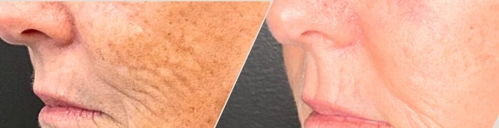 Sun Damage